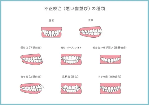 不正咬合(悪い歯並び)の種類