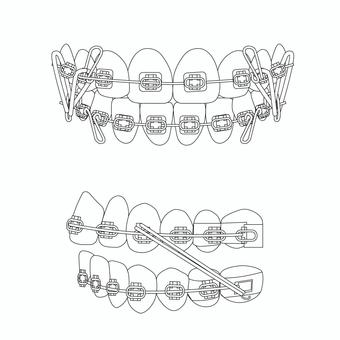 矯正歯科治療の図