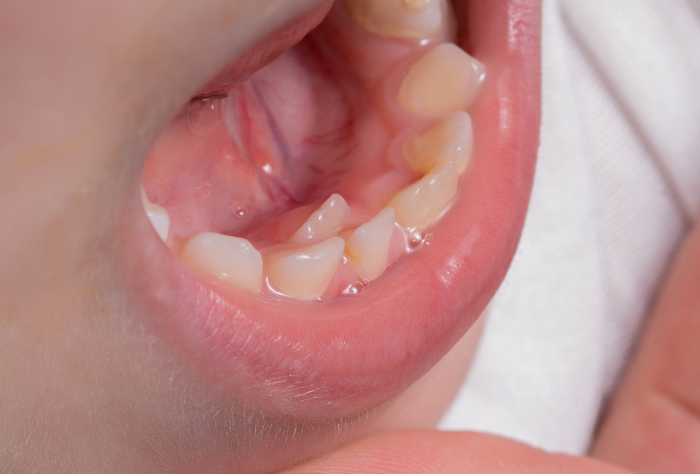 歯のガチャガチャ