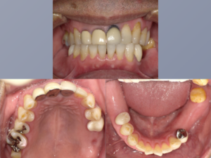 インプラント治療まえ