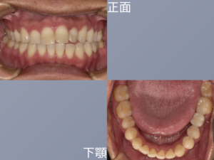 ジルコニアインプラント治療後