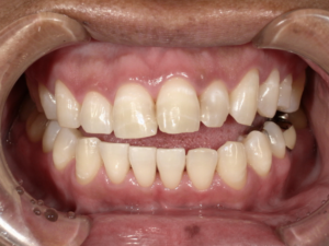 ホワイトニング治療後