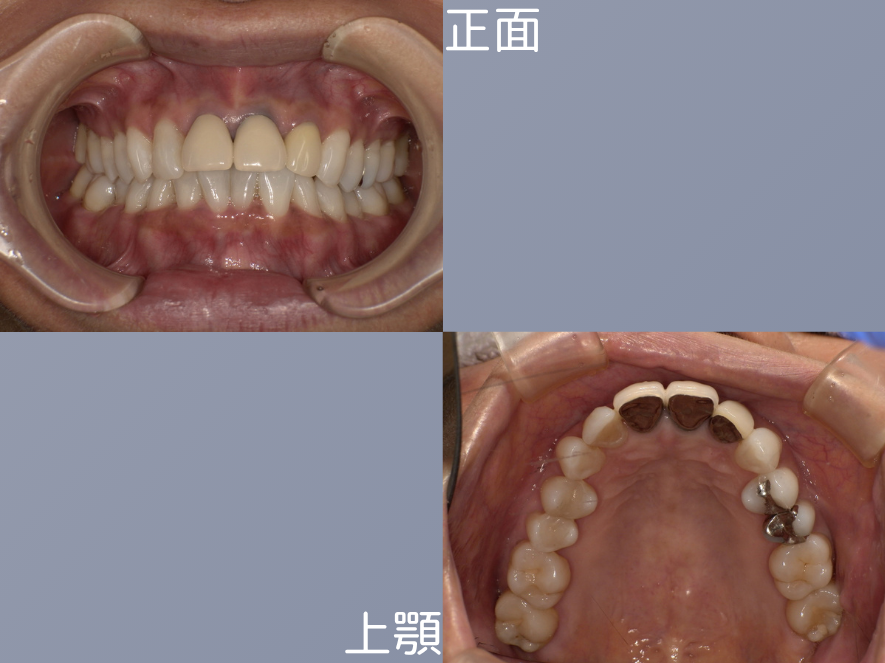オールセラミッククラウンの症例 治療前