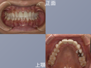 症例後