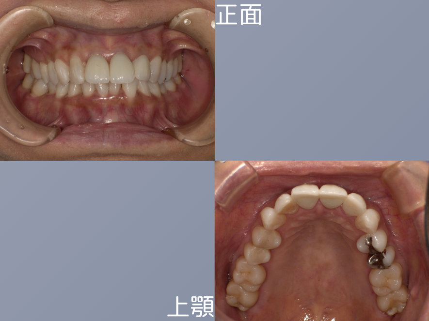 オールセラミッククラウンの症例 治療後