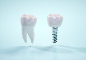 インプラントと歯の写真